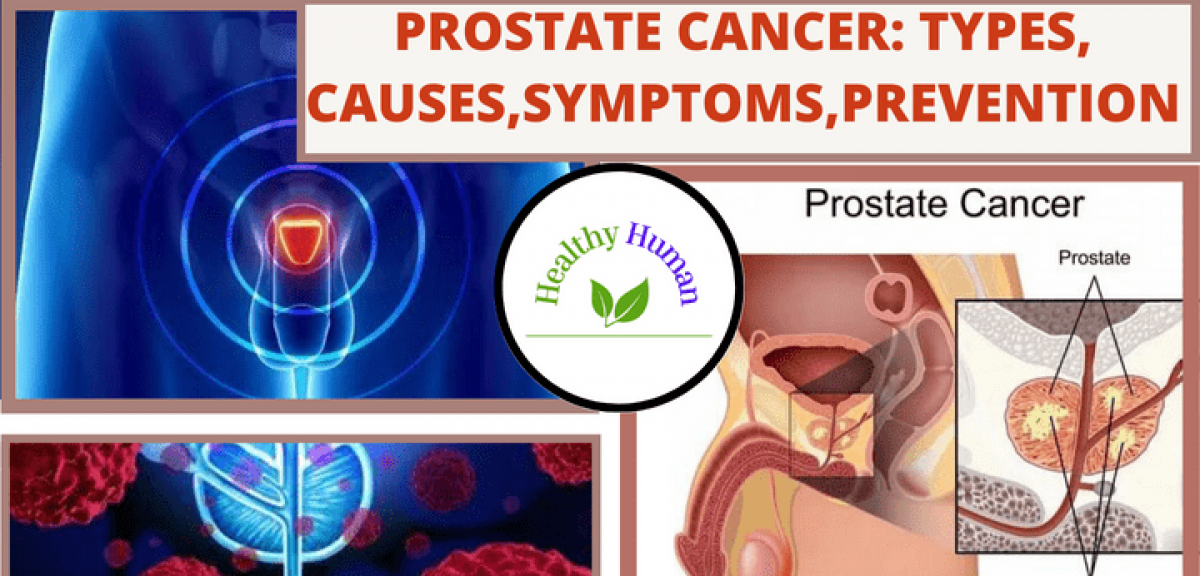 Prostate Cancer Types Causes Symptoms Complication Prevention