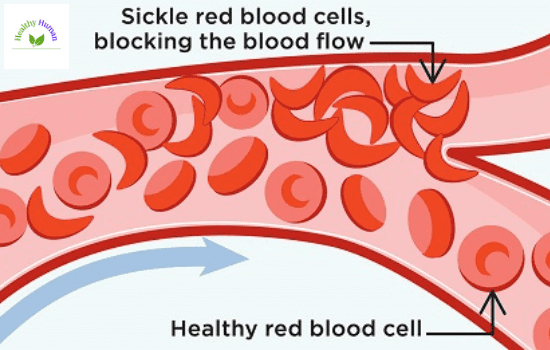 Sickle cell disease