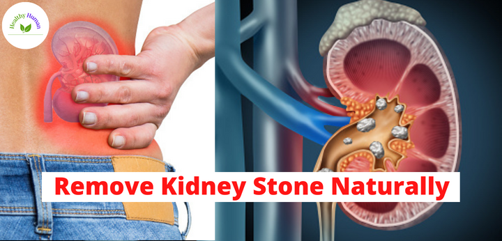 Remove Kidney Stones Naturally | Healthy Life Human