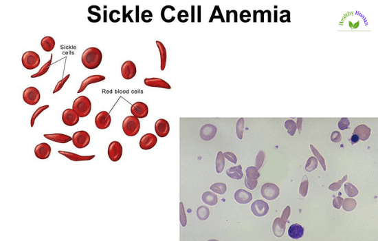 Sickle cell anemia