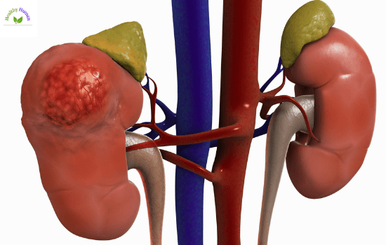 KIDNEY DISEASES