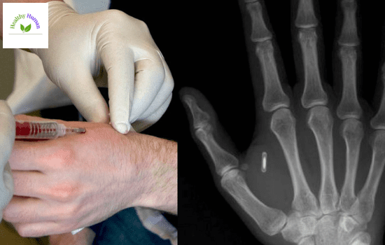 Concern about microchip implantation in human body