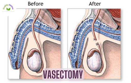 Vasectomy