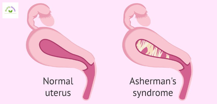 Causes of Asherman's Syndrome