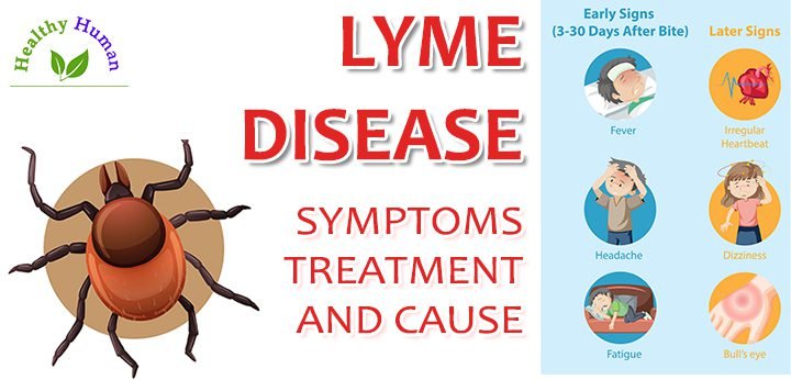 Lyme disease