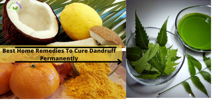 Best home remedies to cure dandruff permanently