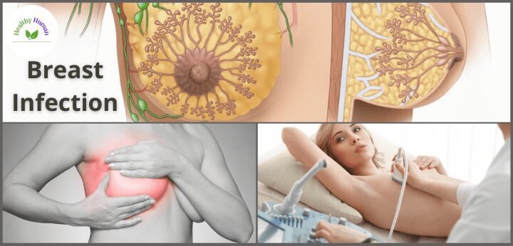 Natural remedies for breast infection