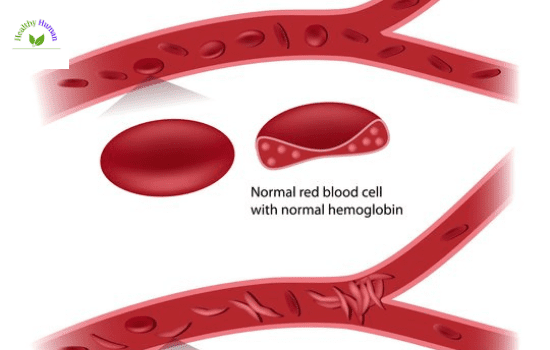 sickle cell