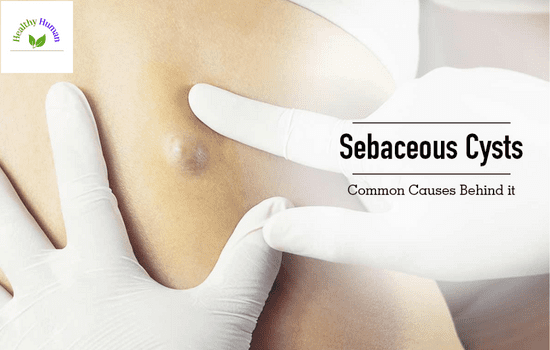 Causes of Sebaceous Cysts