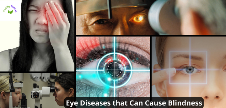 Eye disease that Can Cause Blindness