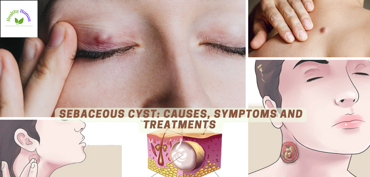 Sebaceous Cysts Causes Symptoms And Treatments 