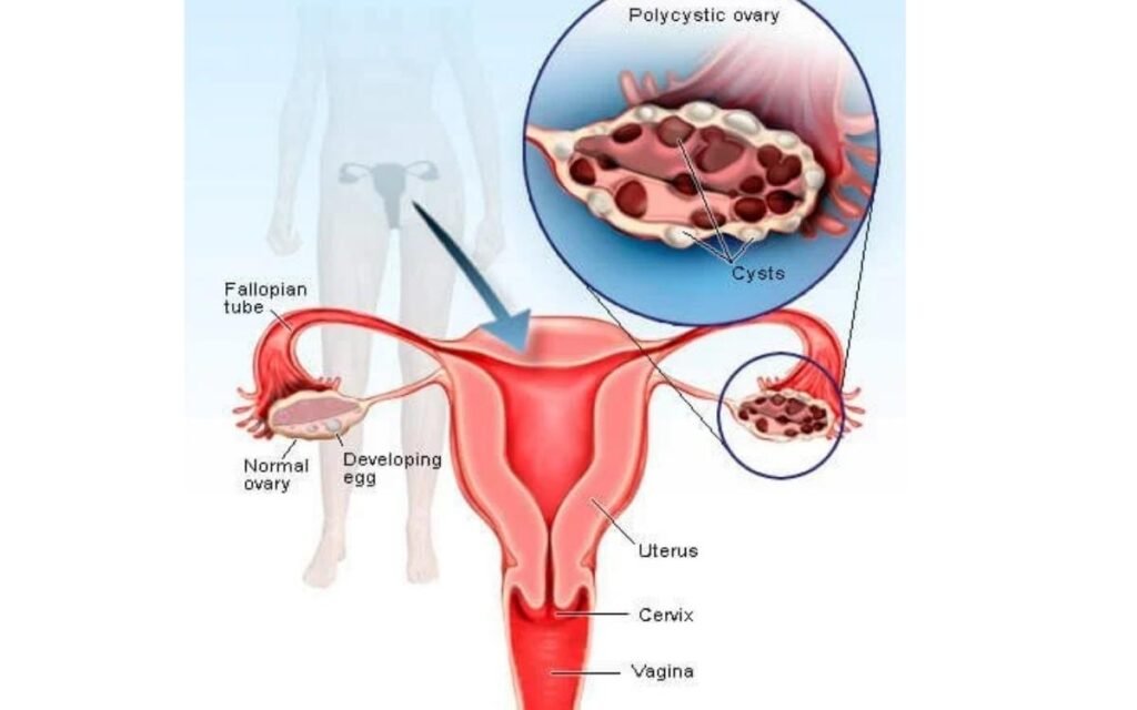 Associated Conditions In Polycystic Ovary Syndrome