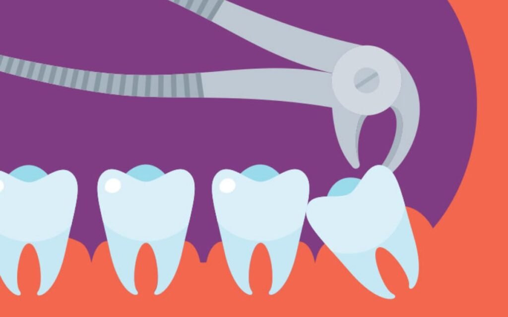 Benefits of removing Wisdom teeth