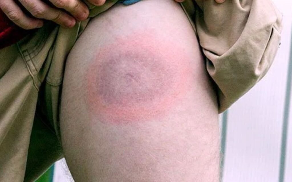 Identification of Lyme disease