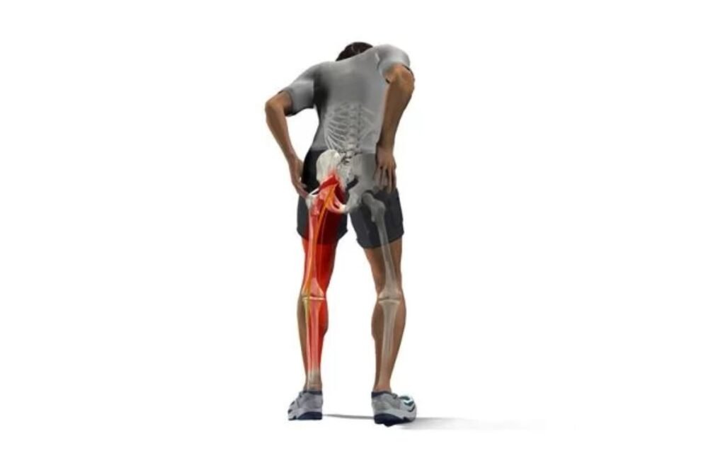Symptoms and signs of piriformis syndrome
