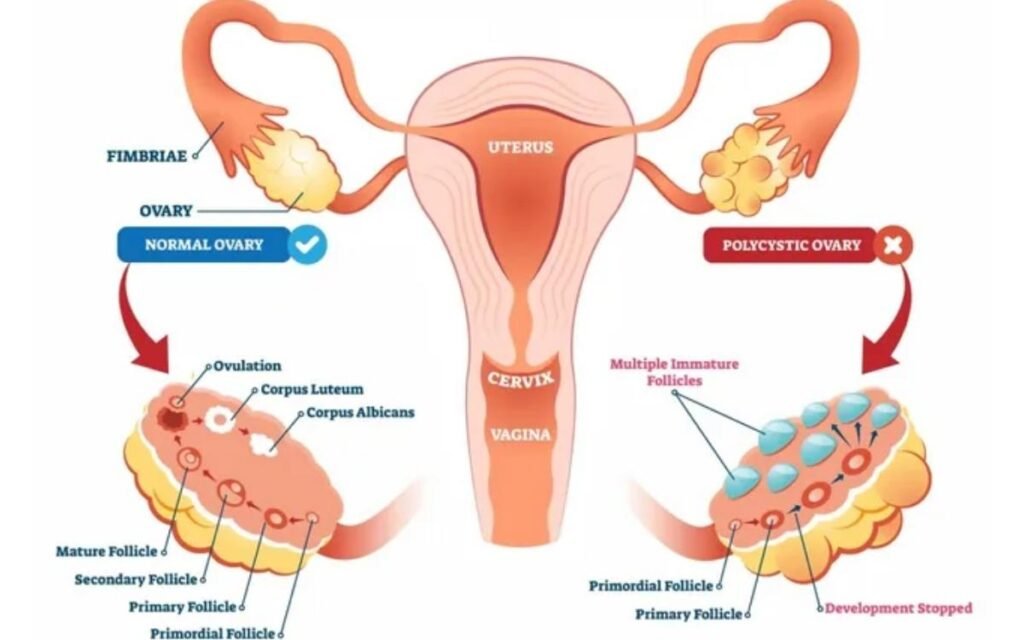 What is Polycystic Ovary Syndrome Disorder