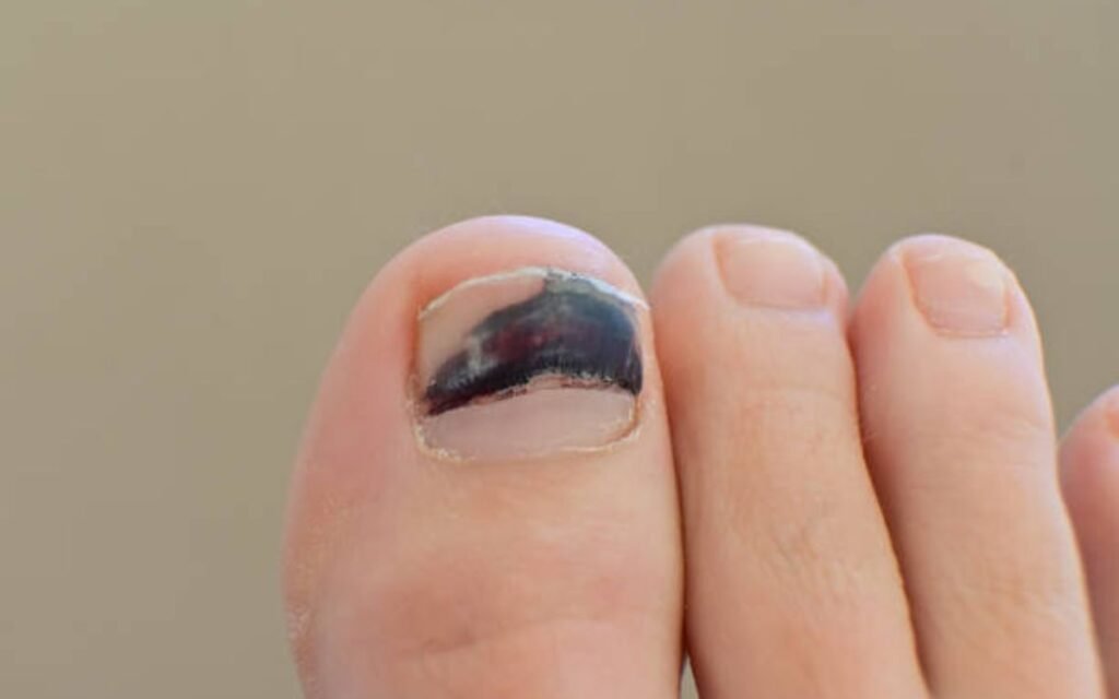 Black Toenail Causes