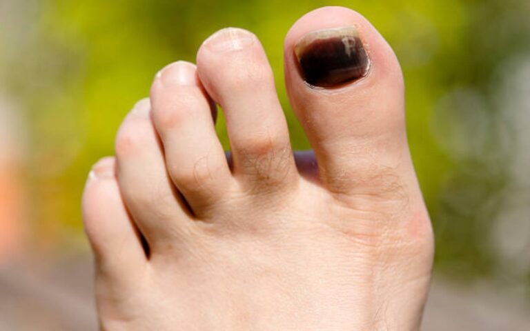 black toenail