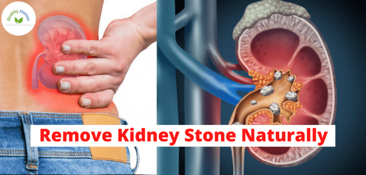 remove kidney stone naturally