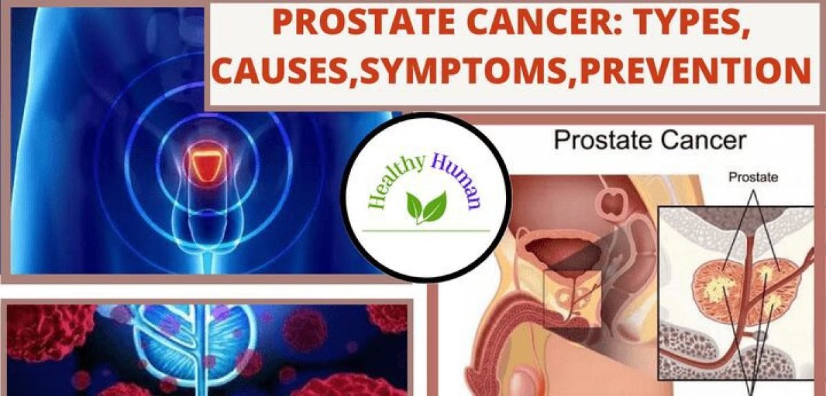 PROSTATE CANCER : TYPES, CAUSES, SYMPTOMS