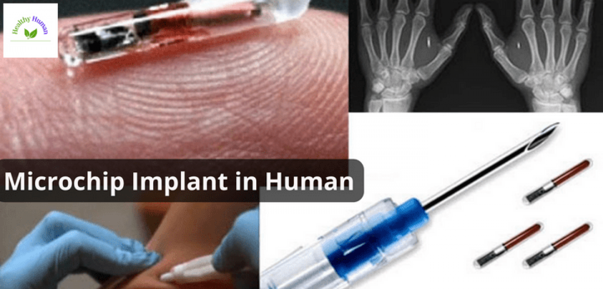 Microchip Implants In Human
