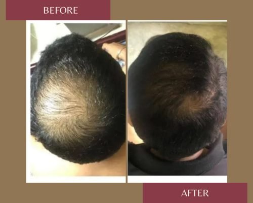 Minoxidil Before And After