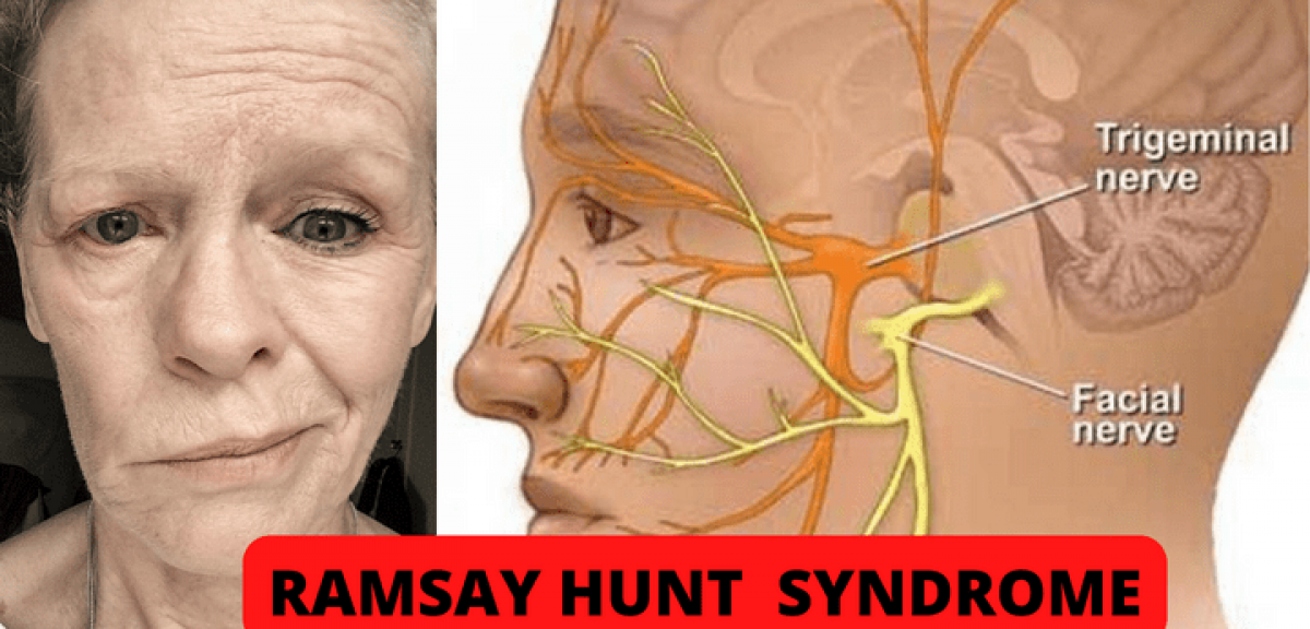 Ramsay hunt syndrome