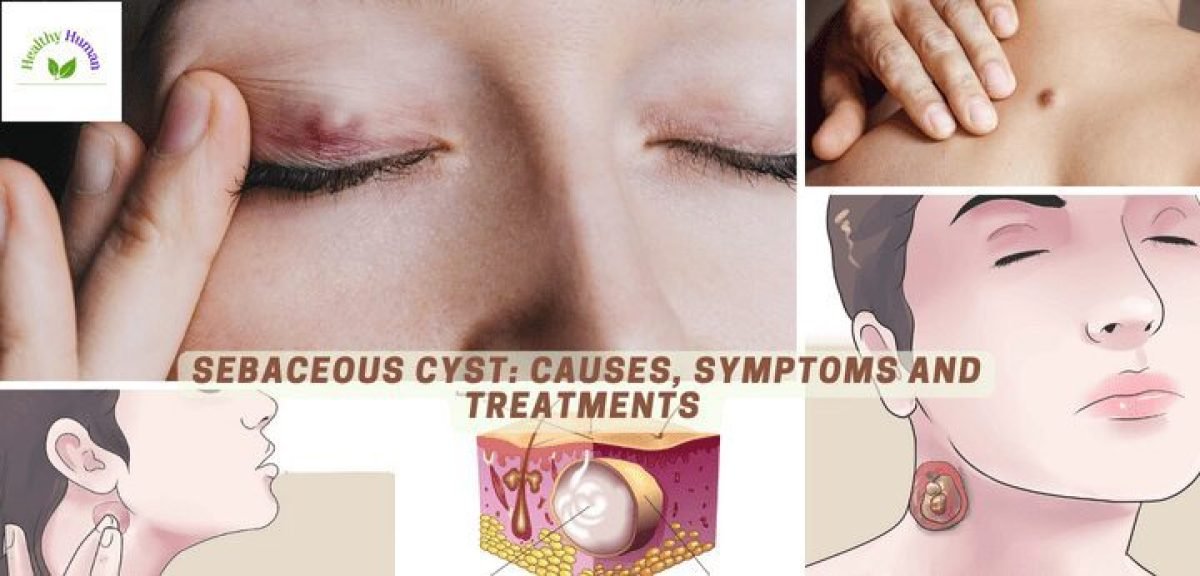 Sebaceous Cysts Causes, Symptoms and Treatments